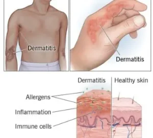 Image showing details about Dermatitis