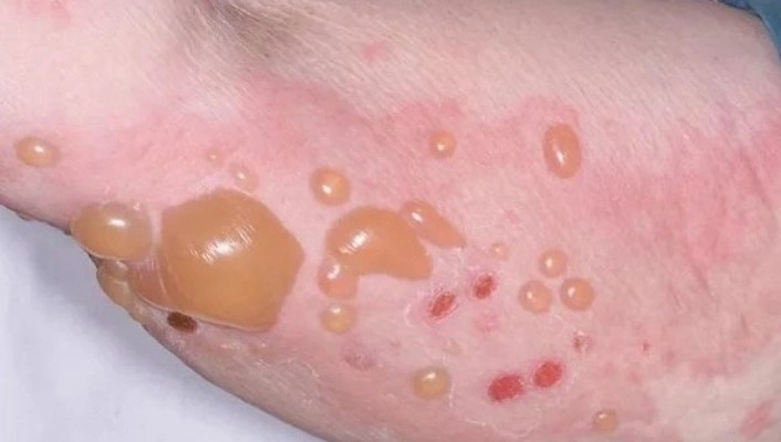 Bullous_Pemphigoid_image