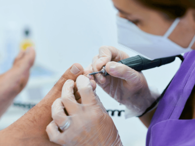 Laser Nail treatment