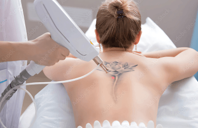 Laser_tattoo_removal