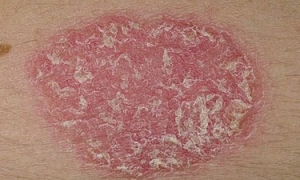 Psoriasis