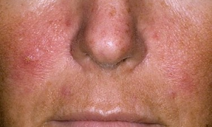 Rosacea